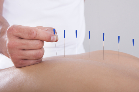 Intramuscular Stimulation / IMS/ Dry Needling/ Acupuncture